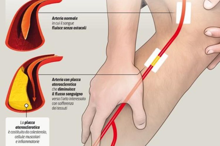 malattia arterie