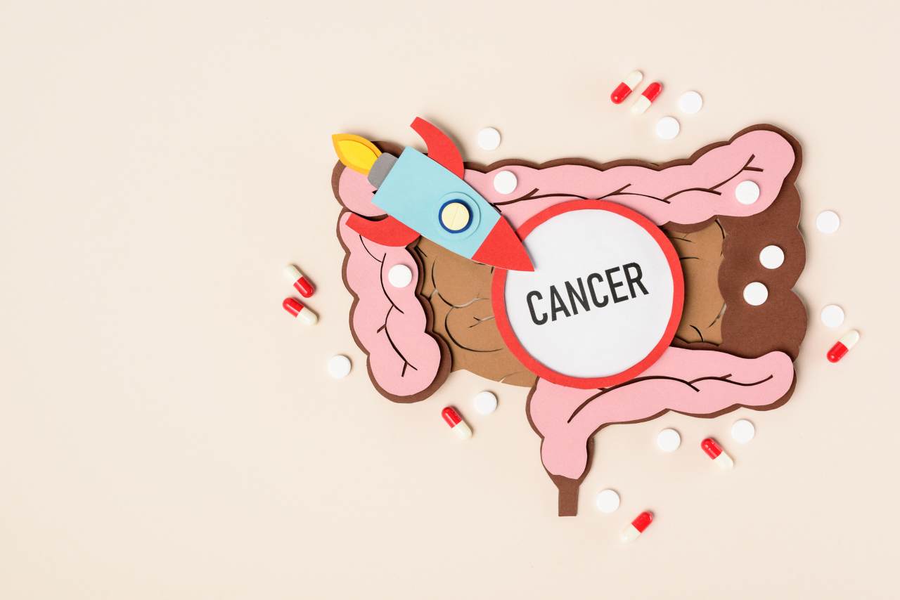 cancro al colon 